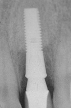 implant placement.