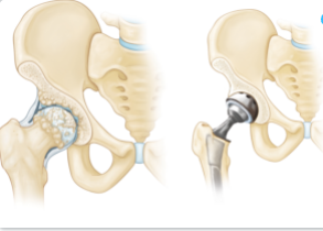 Diagram showing joint replacement surgery