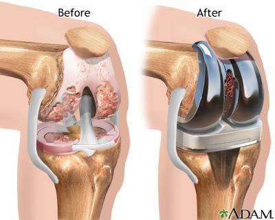 Diagram showing joint replacement surgery